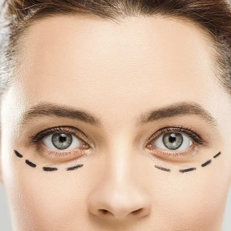 Corrección de ojeras