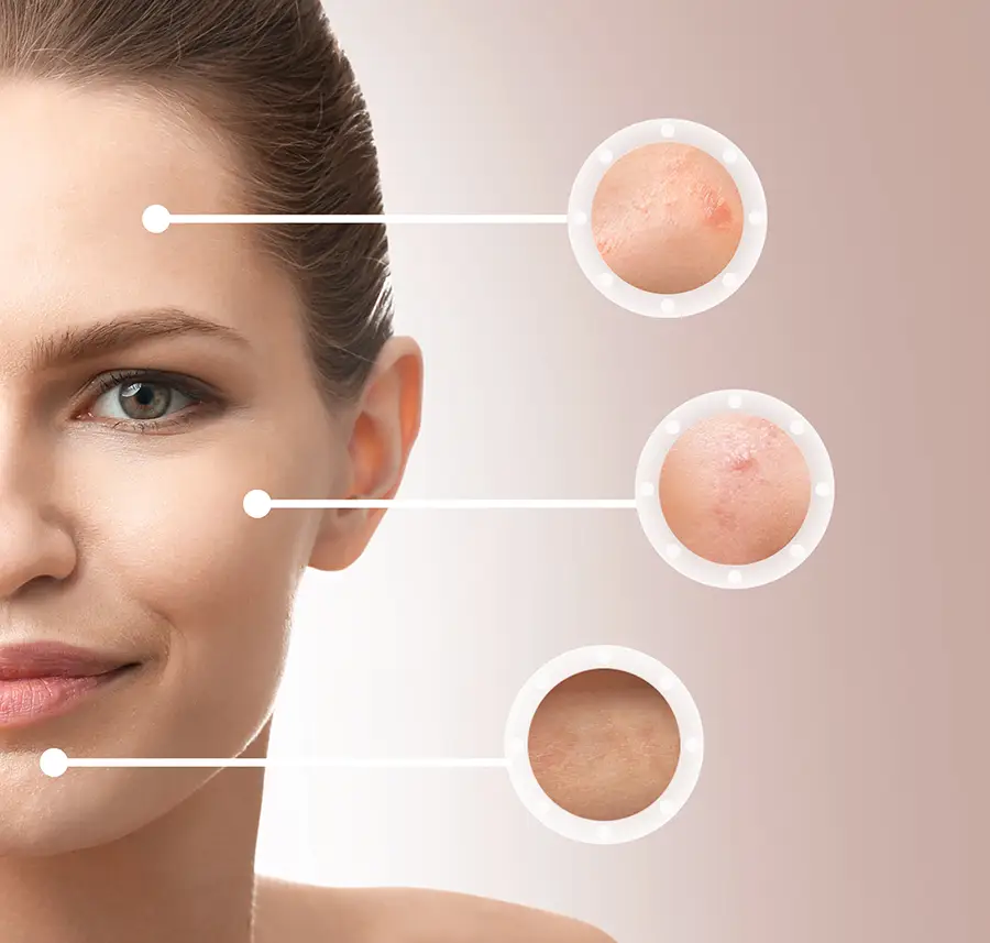 Tratamiento IPL facial